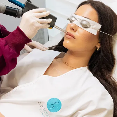 Αποτρίχωση Laser στο Άνω Χείλος: Όλα Όσα Πρέπει να Ξέρεις Πριν την Πρώτη Συνεδρία
