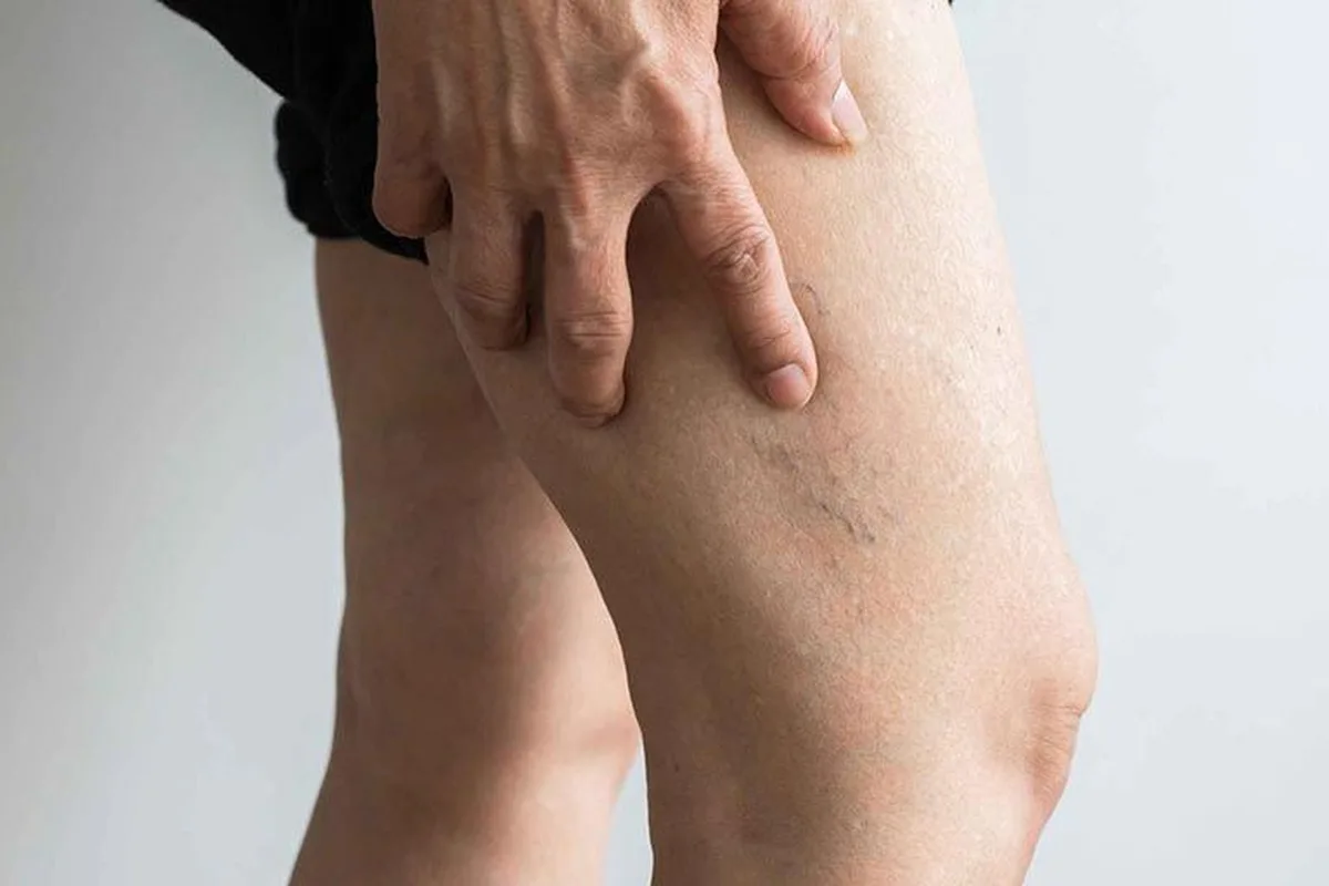sklirotherapia