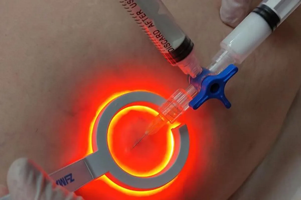 sklirotherapia