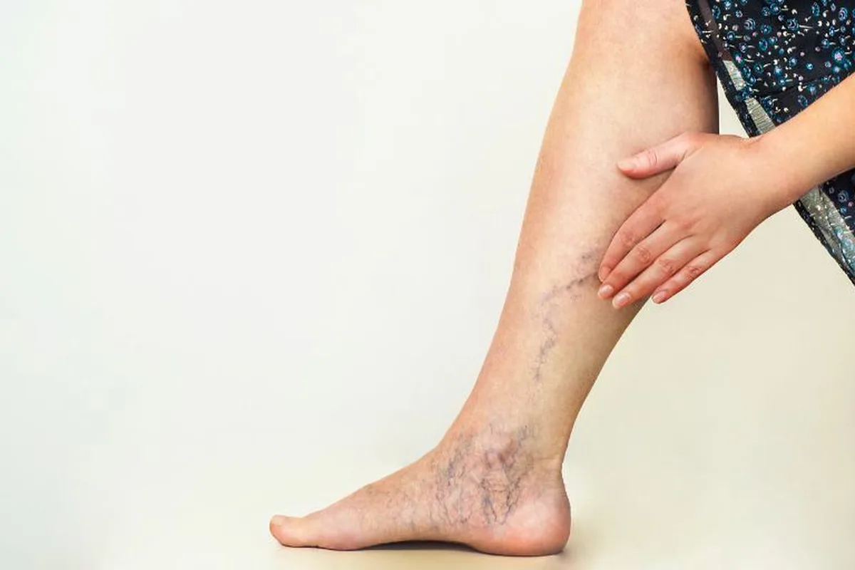 sklirotherapia