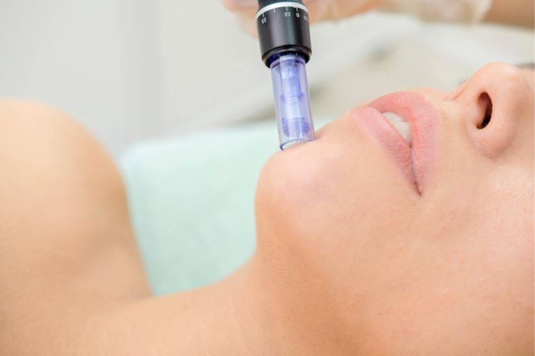 Θεραπεία Dermapen 4 θεραπεία dermapen διαδικασία