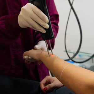 Αποτρίχωση με λέιζερ στα αντιβράχια