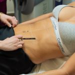 ΑΠΟΤΡΙΧΩΣΗ LASER ΓΡΑΜΜΗ ΚΟΙΛΙΑΣ