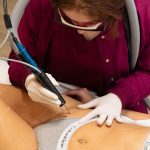 ΑΠΟΤΡΙΧΩΣΗ ΛΕΙΖΕΡ ΓΡΑΜΜΗ ΜΠΙΚΙΝΙ