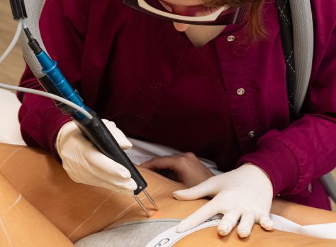 ΑΠΟΤΡΙΧΩΣΗ ΛΕΙΖΕΡ ΓΡΑΜΜΗ ΜΠΙΚΙΝΙ