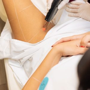 Αποτρίχωση λέιζερ στους μηρούς