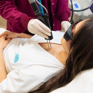 Αποτρίχωση με λέιζερ στη γραμμή στήθους (ντεκολτέ)