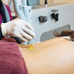 ΑΠΟΤΡΙΧΩΣΗ LASER οσφυϊκή ΧΩΡΑ