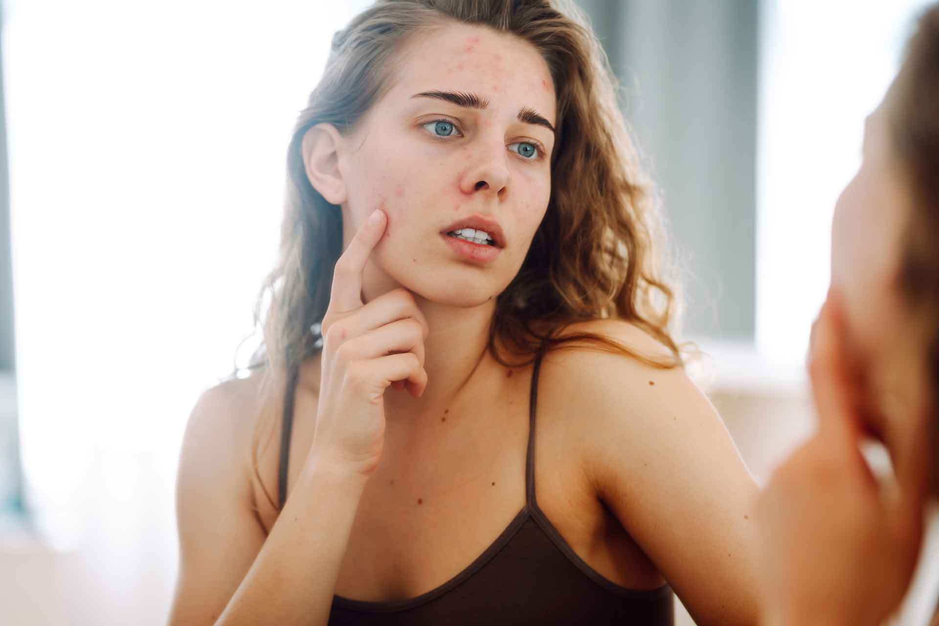 Βαθύς καθαρισμός προσώπου ως λύση για την ακμή