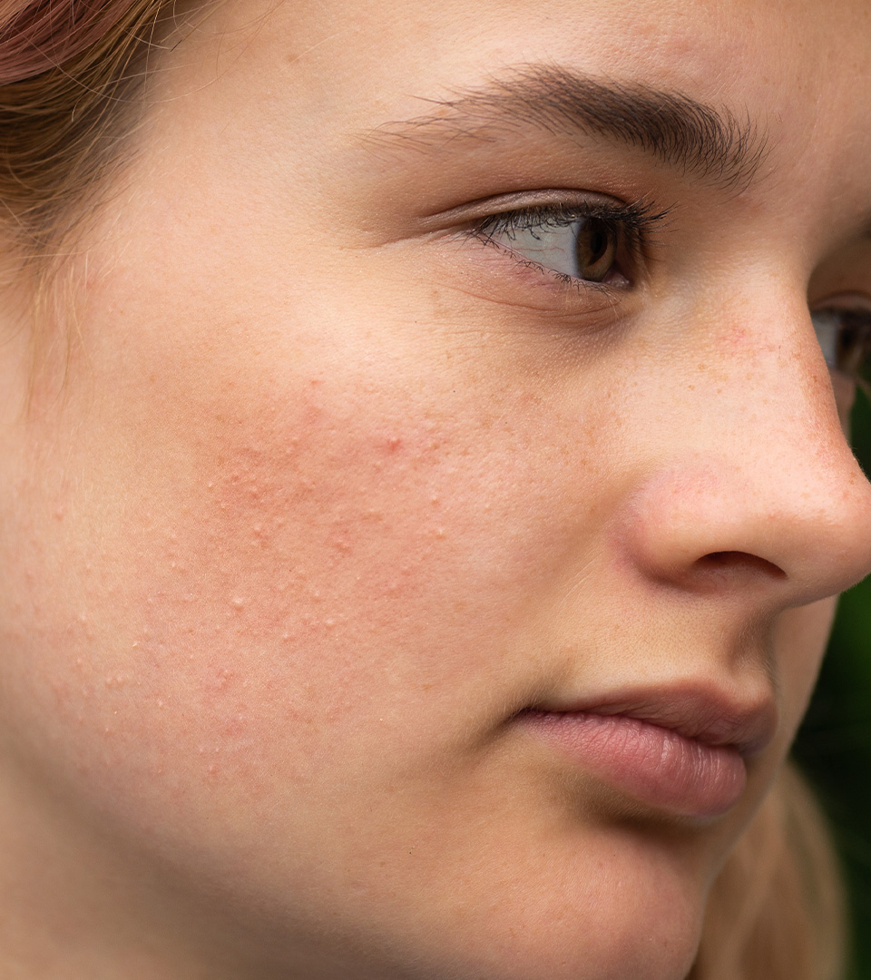 Μεσοθεραπεία προσώπου για ακμή και βελτίωση της επιδερμίδας