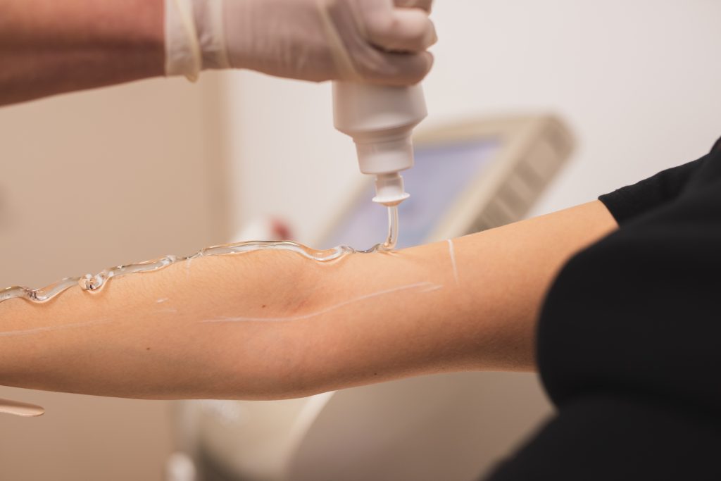 Laser αποτρίχωση για μαυρισμένο δέρμα 1 Laser αποτρίχωση για μαυρισμένο δέρμα