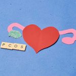 Αποτρίχωση λέιζερ σε γυναίκα με πολυκυστικές ωοθήκες