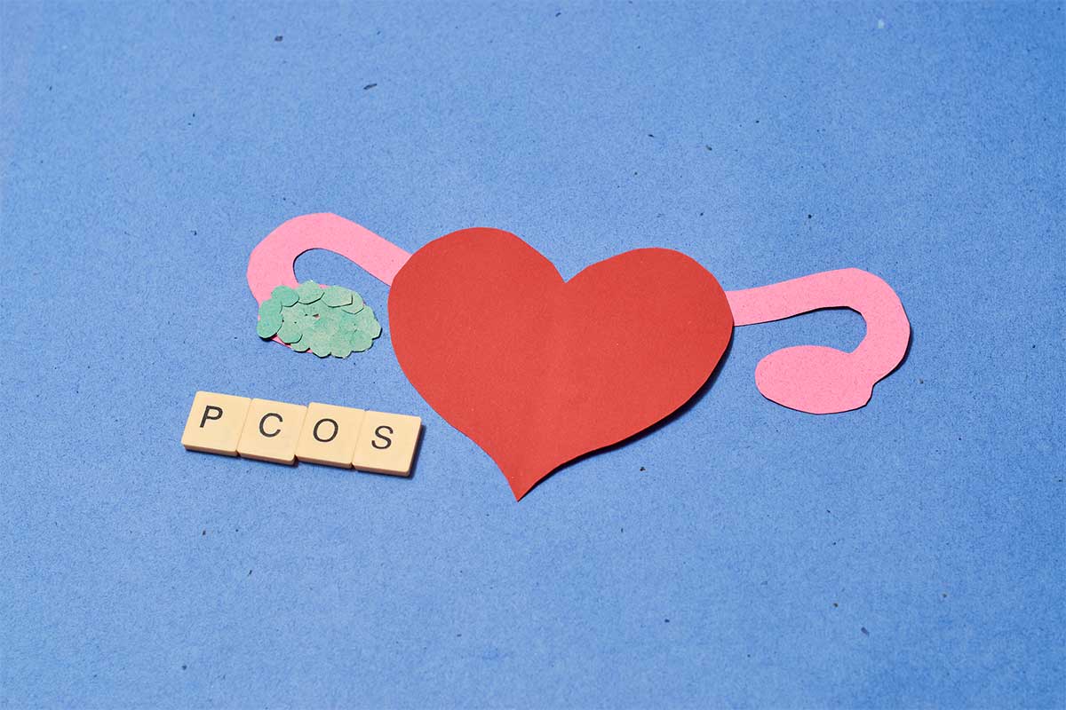 Αποτρίχωση λέιζερ σε γυναίκα με πολυκυστικές ωοθήκες