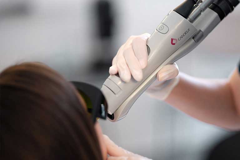Laser Αλεξανδρίτη Candela Gentlelase Pro U 2 Αποτρίχωση στο πρόσωπο με candela prou αλεξανδριτη