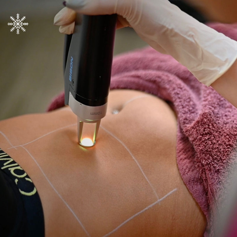 5 αποτρίχωση στην κοιλιά για γυναίκες