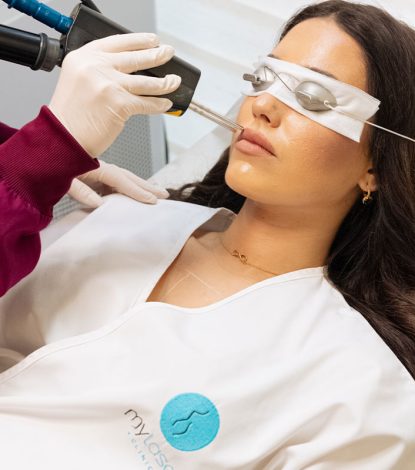 ΑΠΟΤΡΙΧΩΣΗ LASER ΑΝΩ ΧΕΙΛΟΣ