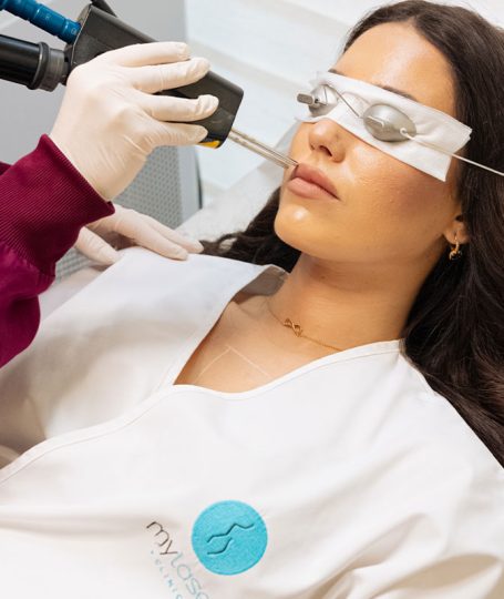 ΑΠΟΤΡΙΧΩΣΗ LASER ΑΝΩ ΧΕΙΛΟΣ