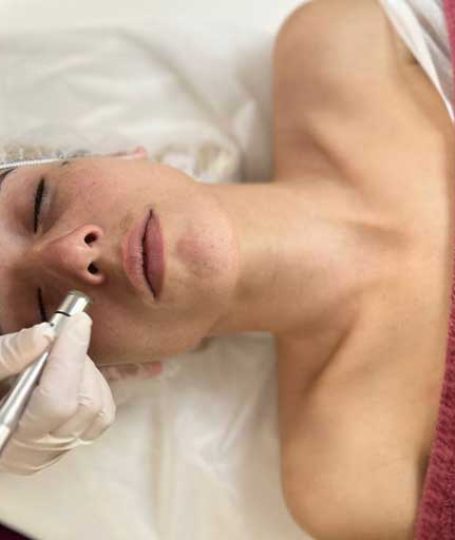 Δερμοαπόξεση Προσώπου