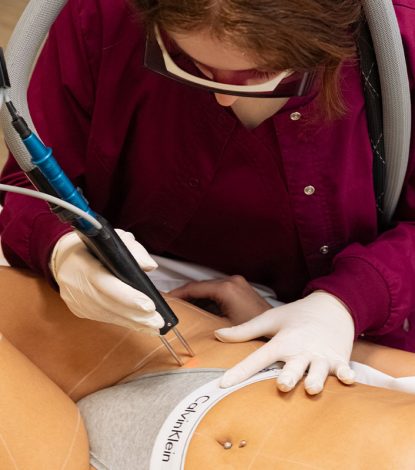 ΑΠΟΤΡΙΧΩΣΗ ΛΕΙΖΕΡ ΓΡΑΜΜΗ ΜΠΙΚΙΝΙ