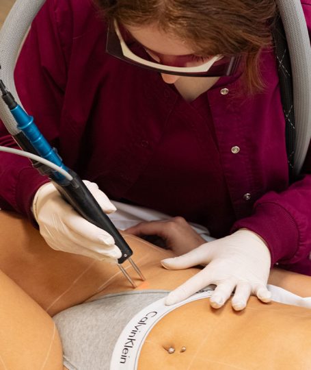 ΑΠΟΤΡΙΧΩΣΗ ΛΕΙΖΕΡ ΓΡΑΜΜΗ ΜΠΙΚΙΝΙ