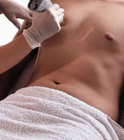 My Laser Clinic - Αποτρίχωση Laser 3 Αποτρίχωση Αλεξανδρίτης σε άντρα με candela gentlelase prou