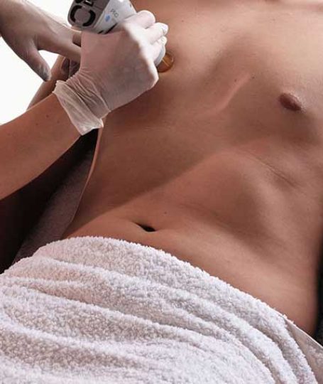 Αποτρίχωση Αλεξανδρίτης σε άντρα με candela gentlelase prou