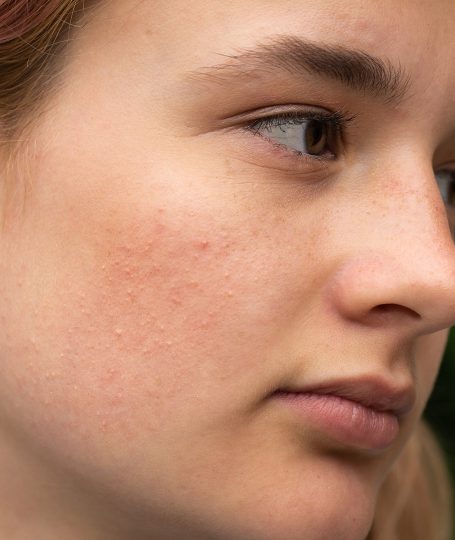 Μεσοθεραπεία προσώπου για ακμή και βελτίωση της επιδερμίδας